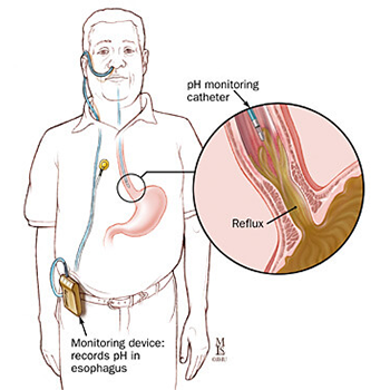 Diagram of 24 hour pH study method