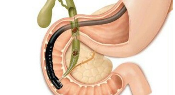 ERCP – Endoscopic Retrograde Cholangiopancreatography