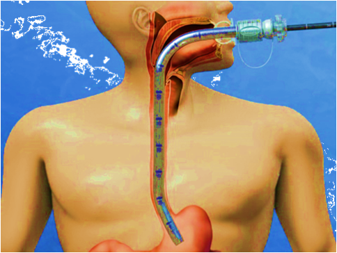 How capsule endoscopy is performed