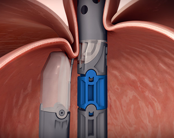 Endoscopic-treatment-of-GERD.png