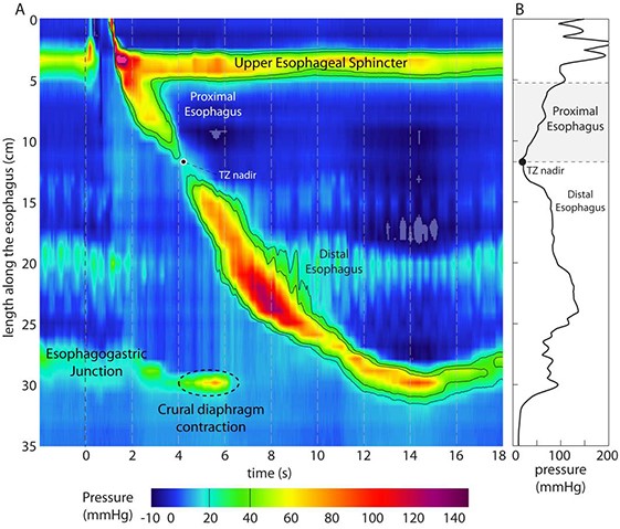 Image showing the process for esophageal manometry