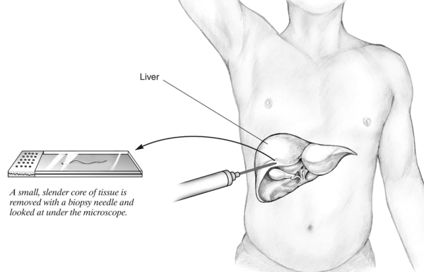 Tissue sample extracted from a liver biopsy