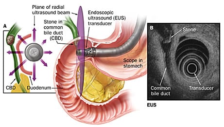 Procedure for EUS test