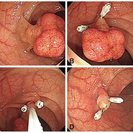 Doctor performing polypectomy
